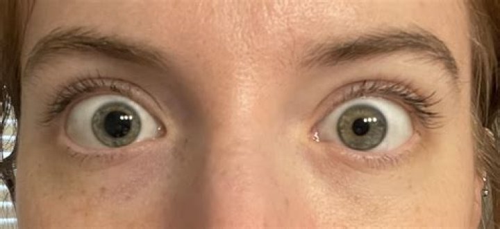 Do dilated eyes make it hard to see up close?
