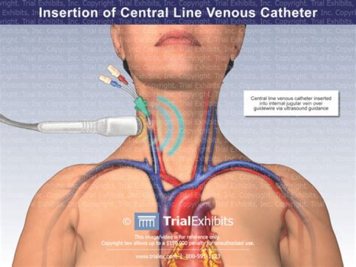 Is a central venous catheter the same as an IV?